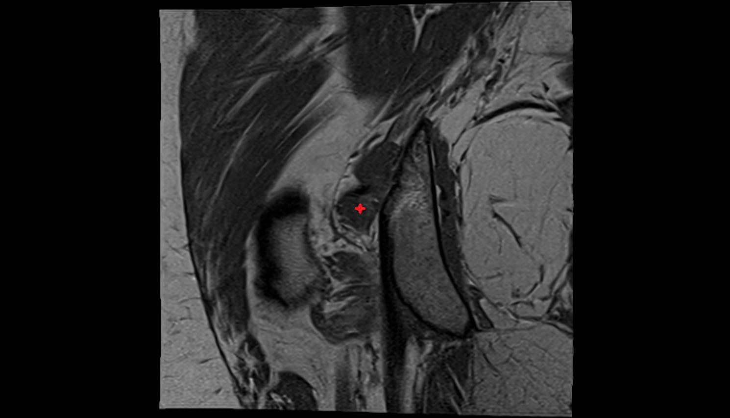 Inferior gemellus muscle MRI coronal  anatomy image