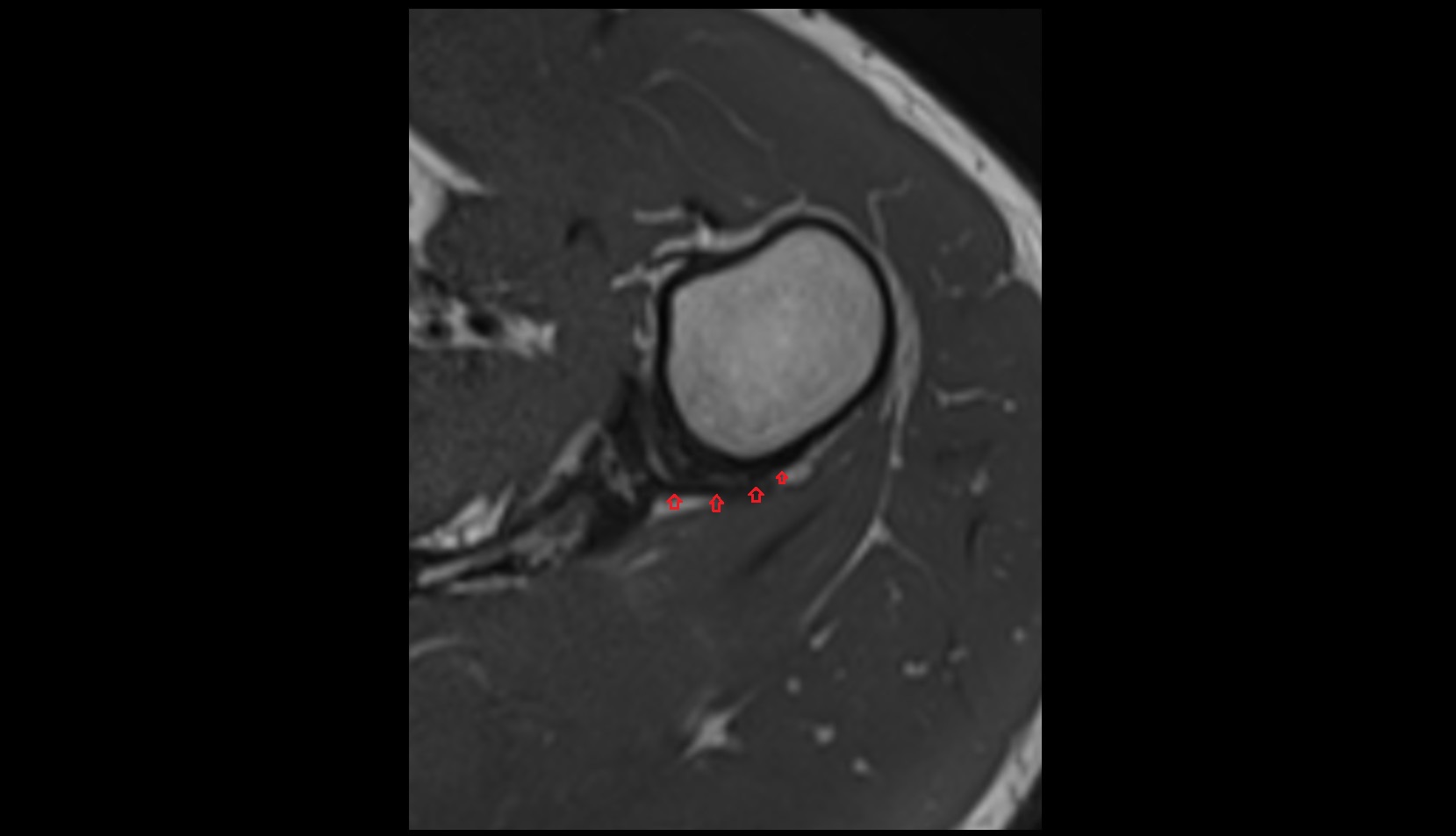 Inferior glenohumeral ligament posterior band mri 1mm axial