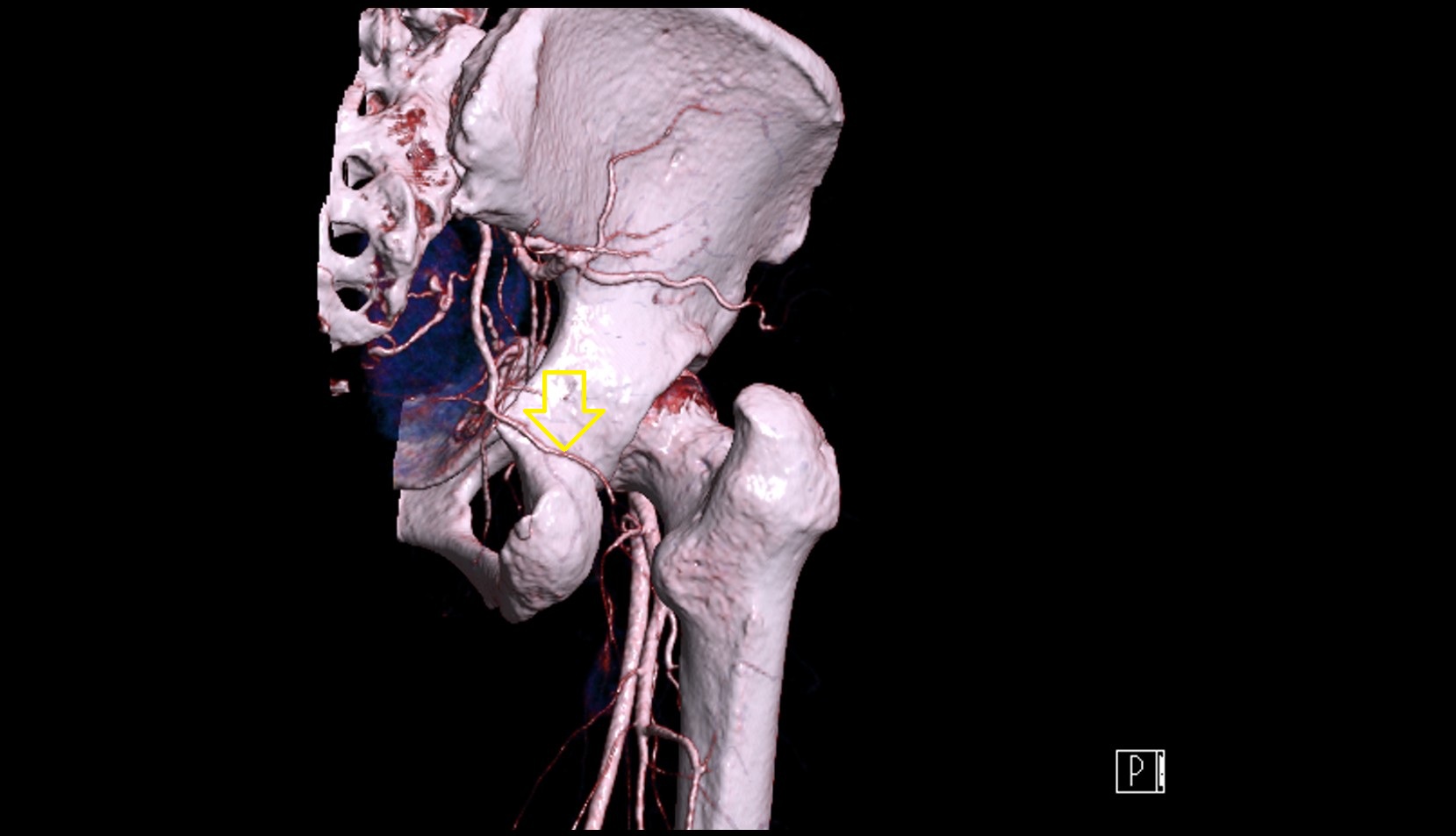 Inferior gluteal artery CT 3D VRT anatomy image