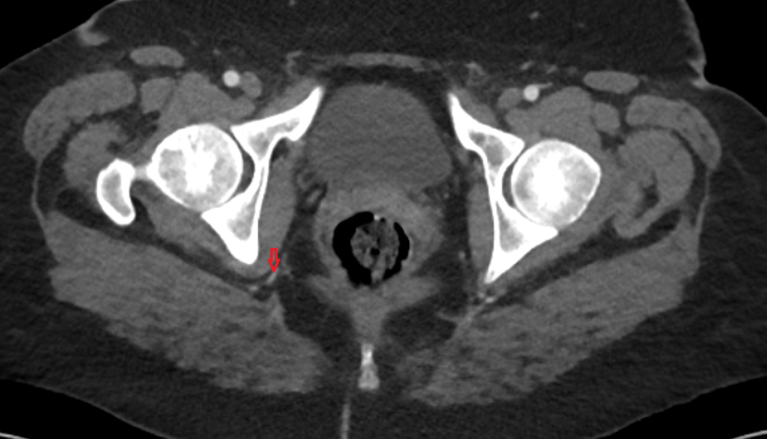 Inferior gluteal artery CT axial image  MRI  axial  anatomy  image-img-00000-00000
