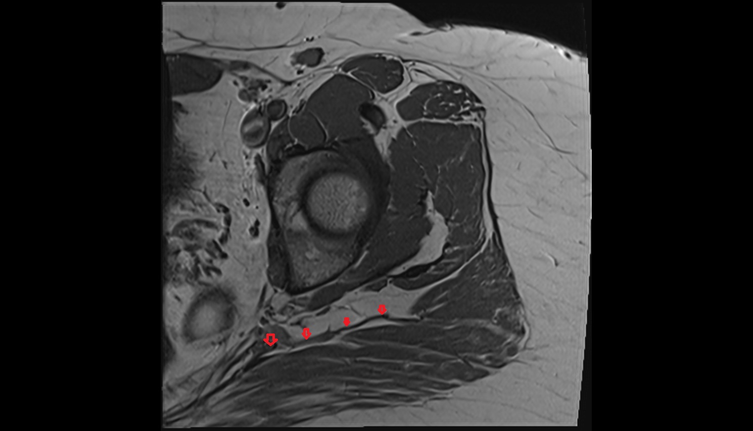 Inferior gluteal artery MRI axial  anatomy image-img-00000-00000