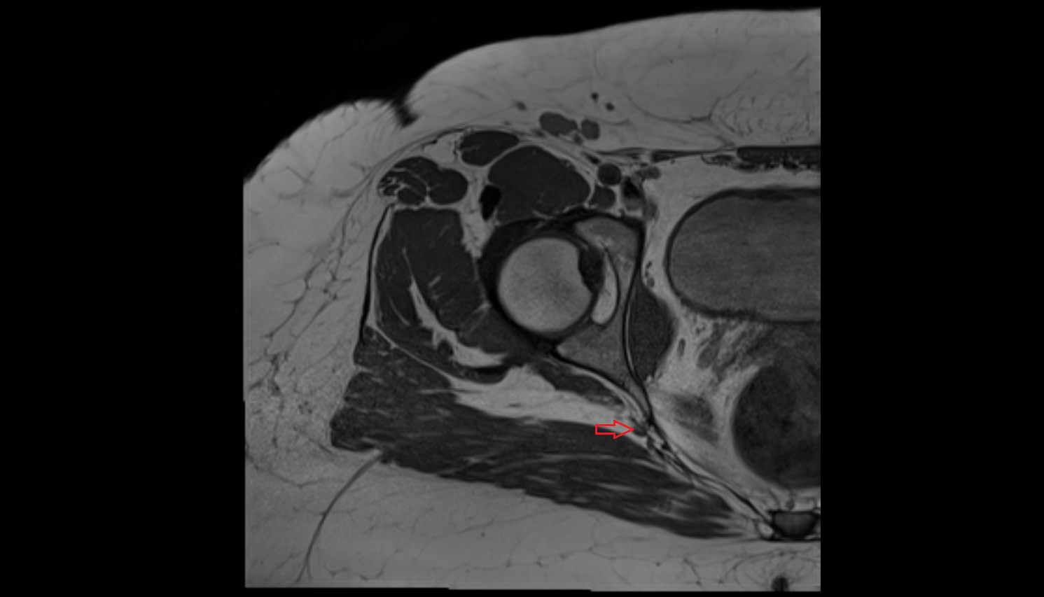 Inferior gluteal artery MRI axial image  MRI  axial  anatomy  image-img-00000-00000