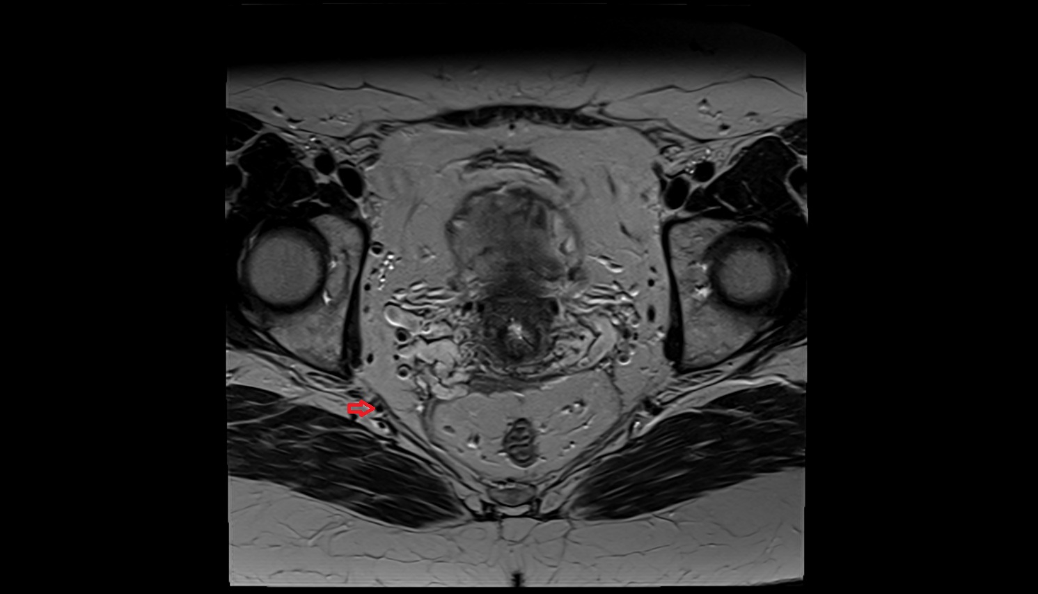 Inferior gluteal artery MRI axial image  MRI  axial  anatomy  image-img-00000-00000_00001