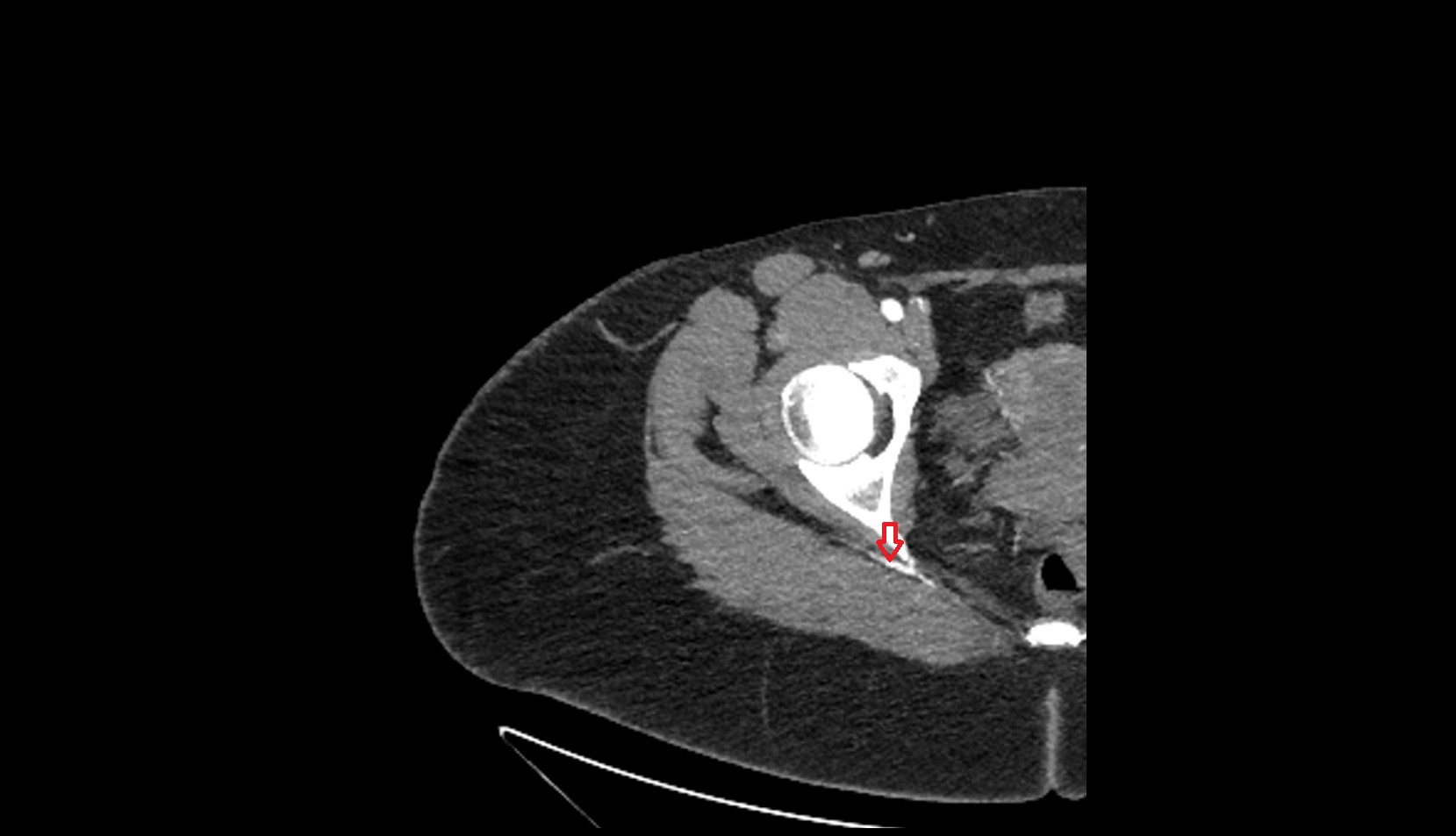 Inferior gluteal artery ct