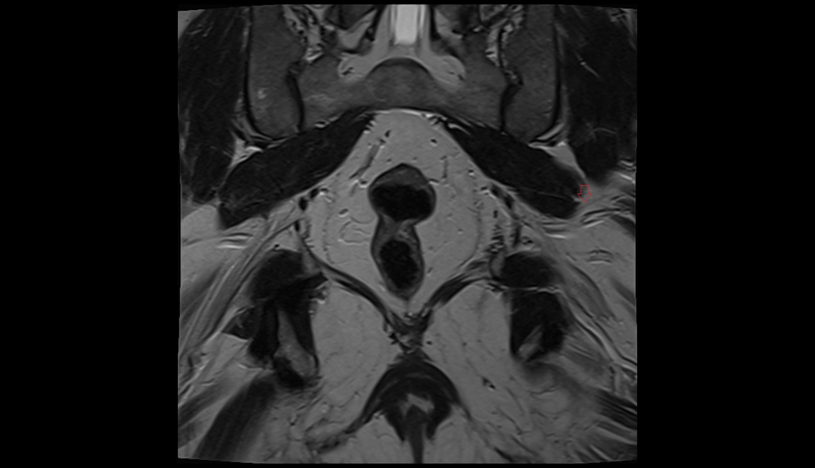 Inferior gluteal nerve MRI