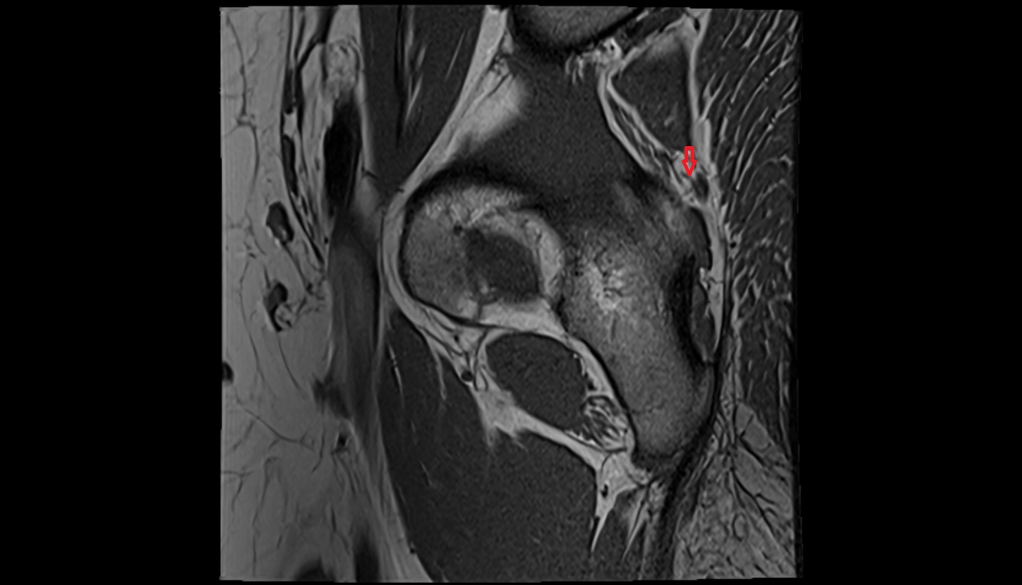 Inferior gluteal nerve  MRI sag  anatomy image-img-00000-00000