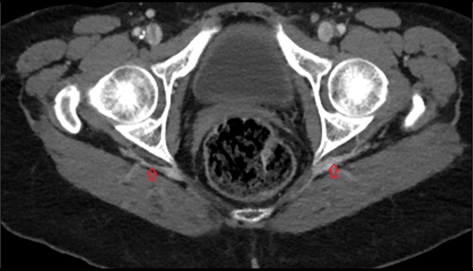 Inferior gluteal vein CT axial images