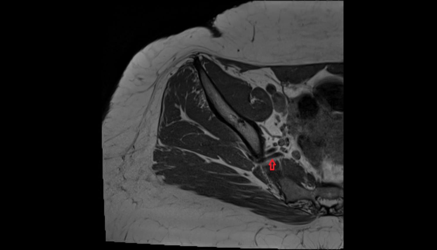 Inferior gluteal vein  MRI  axial  anatomy  image-img-00000-00000