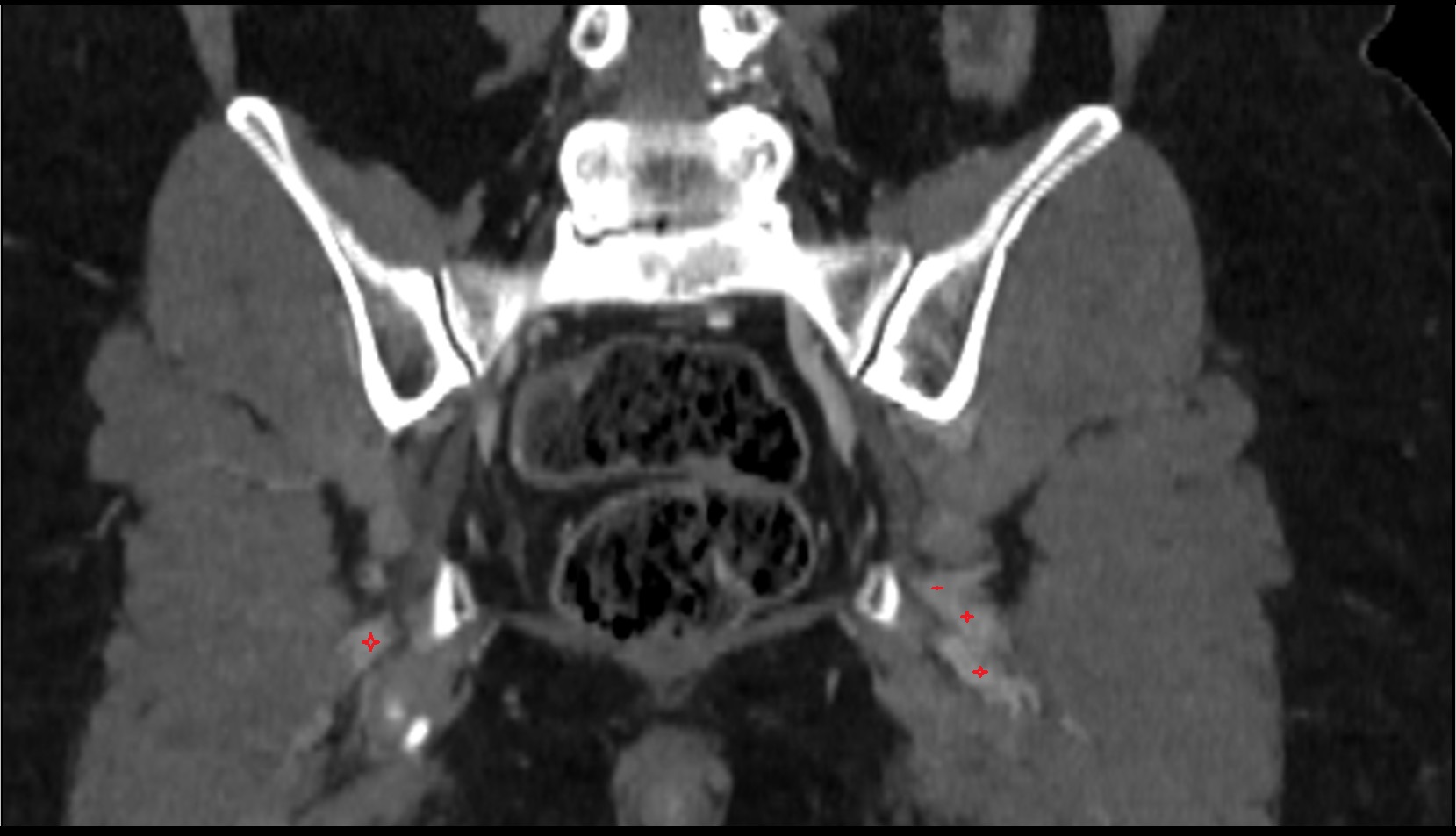 Inferior gluteal vein ct coronal