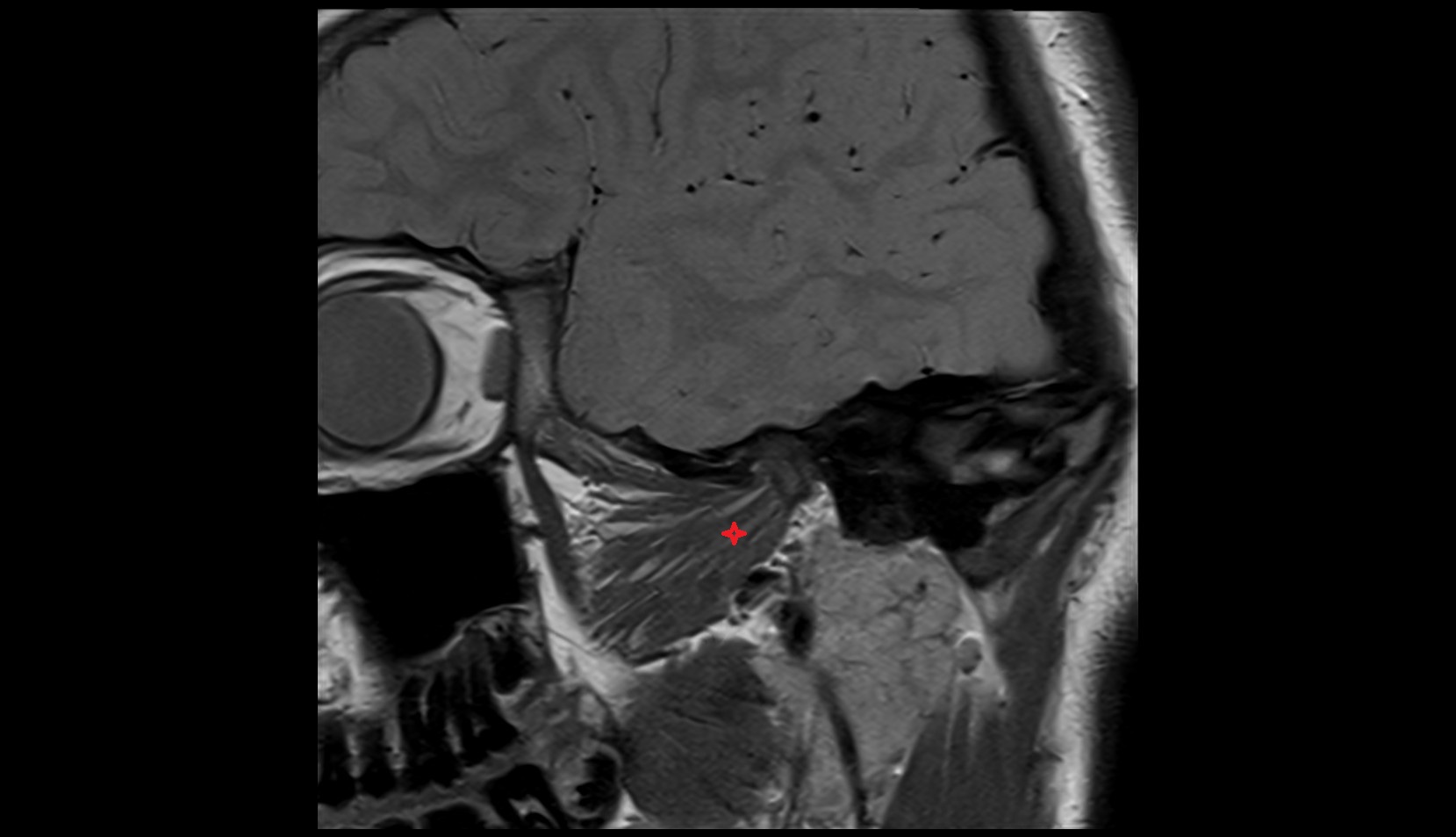 Inferior head of lateral pterygoid muscle mri