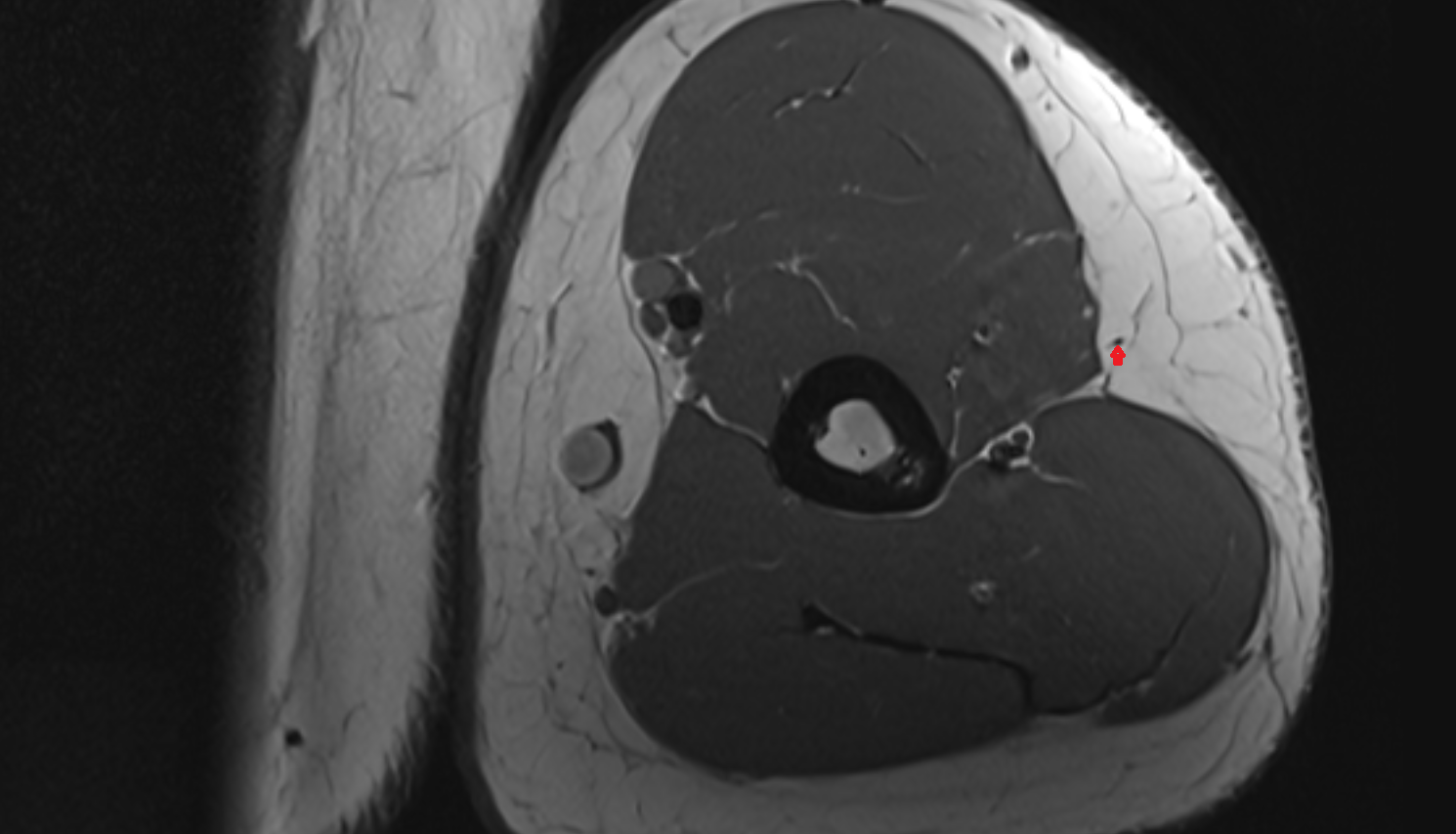 Inferior lateral cutaneous nerve of arm  axial cross sectional anatomy 3T MRI AI enhanced radiology image -img-00000-00000