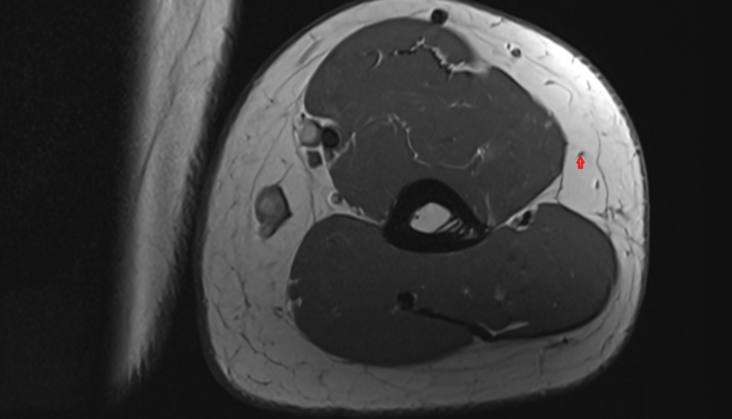 Inferior lateral cutaneous nerve of arm  axial cross sectional anatomy 3T MRI AI enhanced radiology image -img-00000-00000_00001