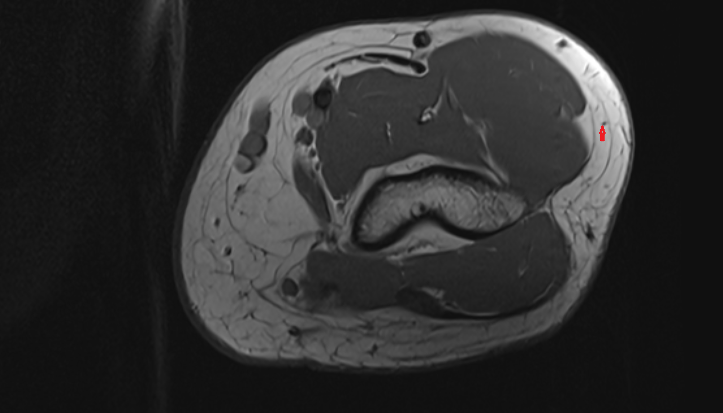Inferior lateral cutaneous nerve of arm  axial cross sectional anatomy 3T MRI AI enhanced radiology image -img-00000-00000_00002