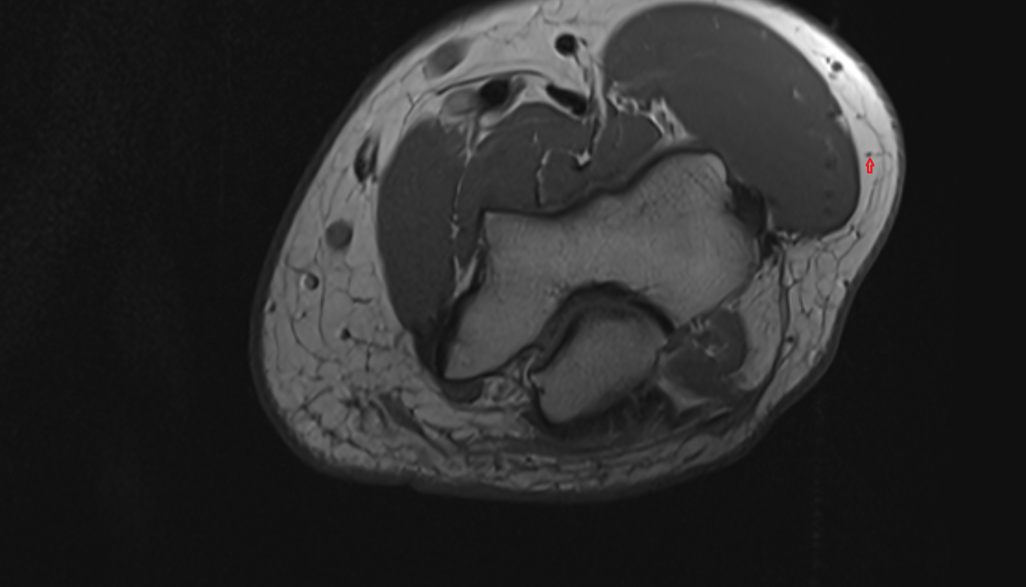 Inferior lateral cutaneous nerve of arm  axial cross sectional anatomy 3T MRI AI enhanced radiology image -img-00000-00000_00003