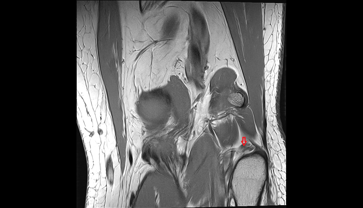 Inferior lateral genicular artery  MRI sag  cross sectional anatomy 3T MRI AI enhanced  radiology  anatomy image-img-00000-00000