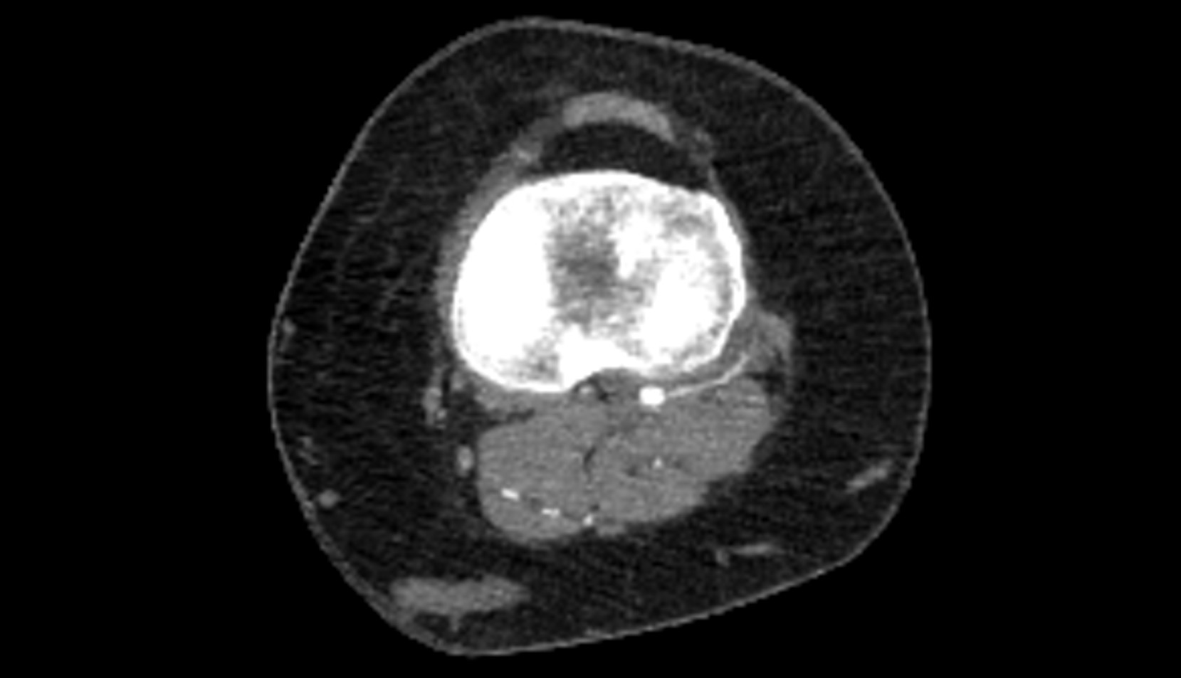 Inferior lateral genicular artery ct  axial image