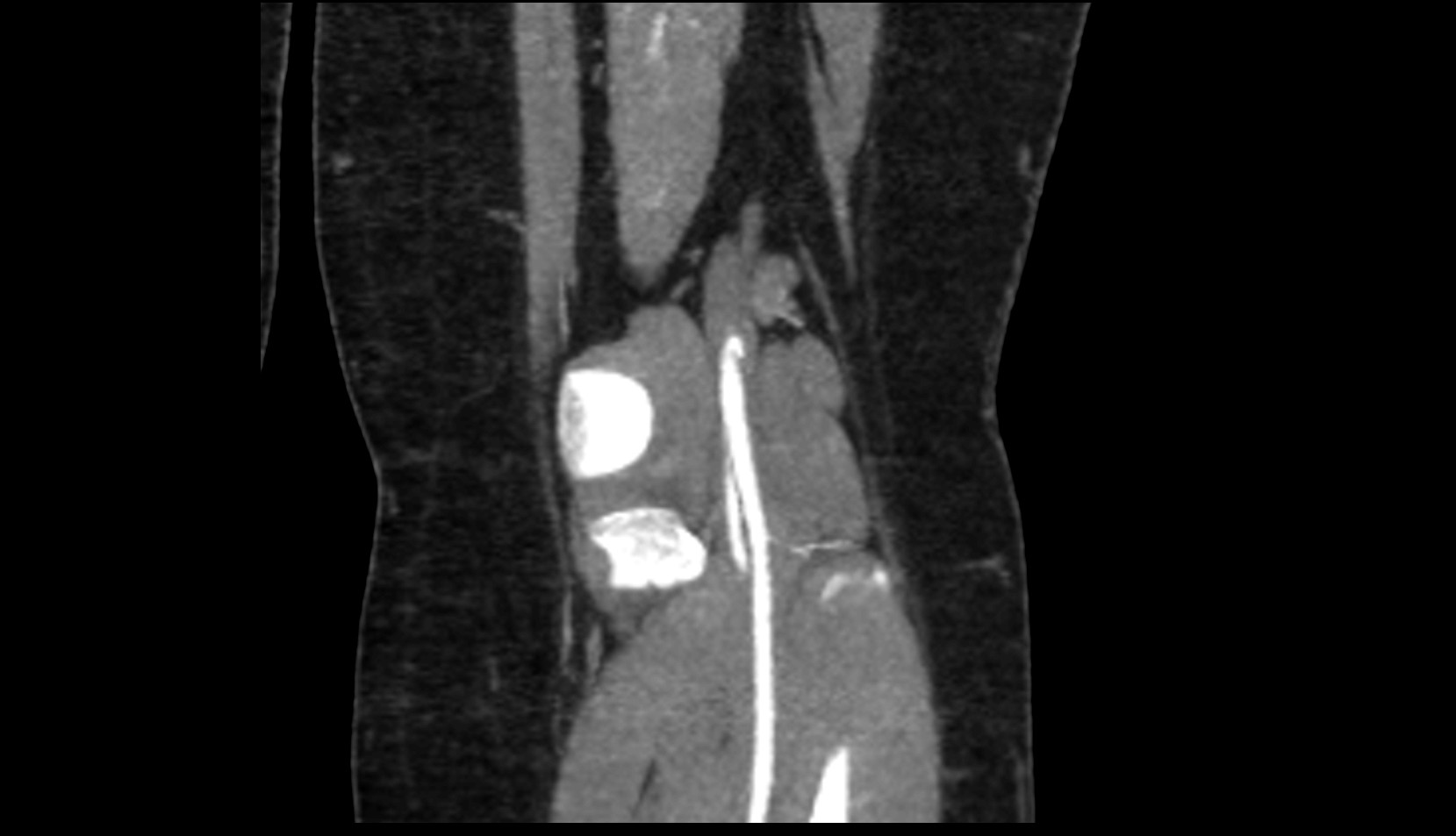 Inferior lateral genicular artery ct coronl image