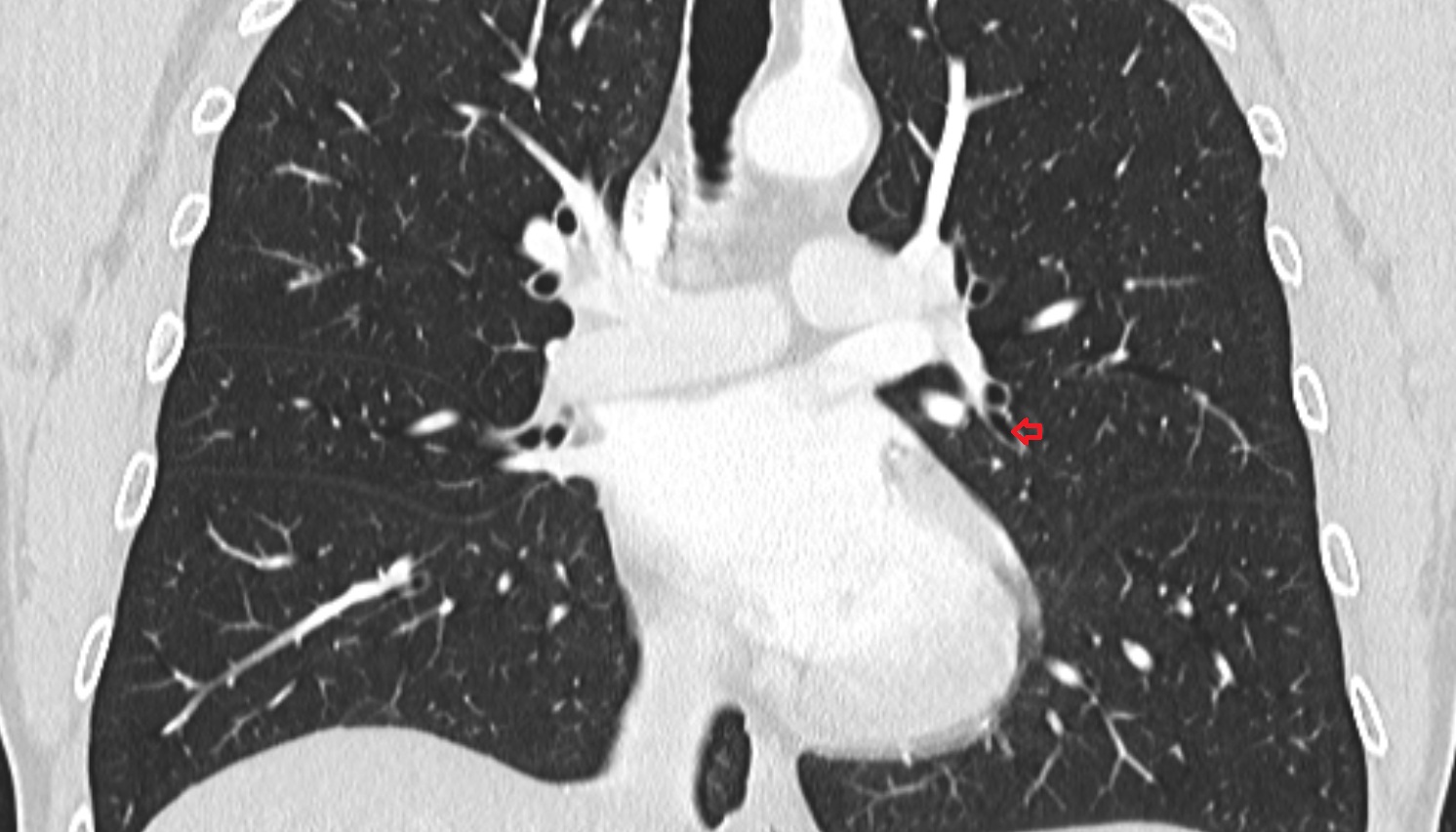Inferior lingular bronchus of left lung (B5)  anatomy  CT coronal  image -img-00000-00000