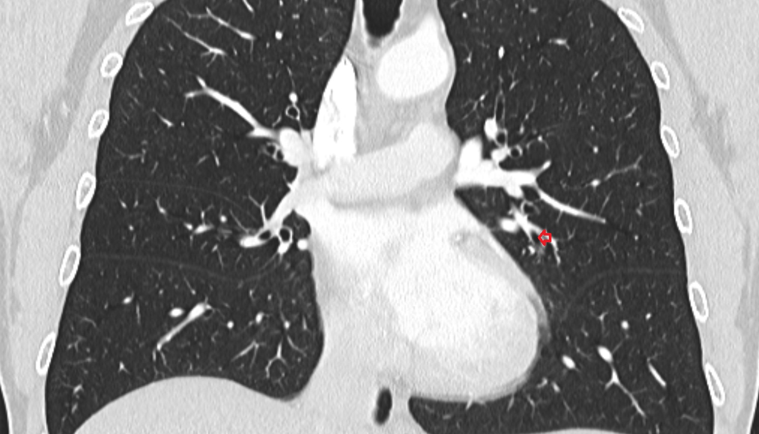 Inferior lingular bronchus of left lung (B5)  anatomy  CT coronal  image -img-00000-00000_00001