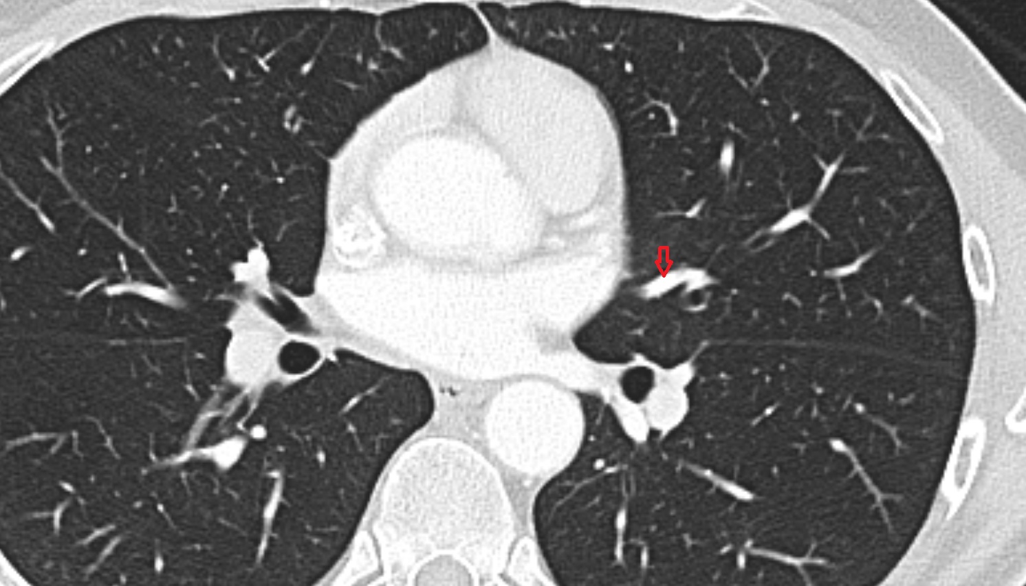 Inferior lingular vein of left lung CT axial image -img-00000-00000_00001