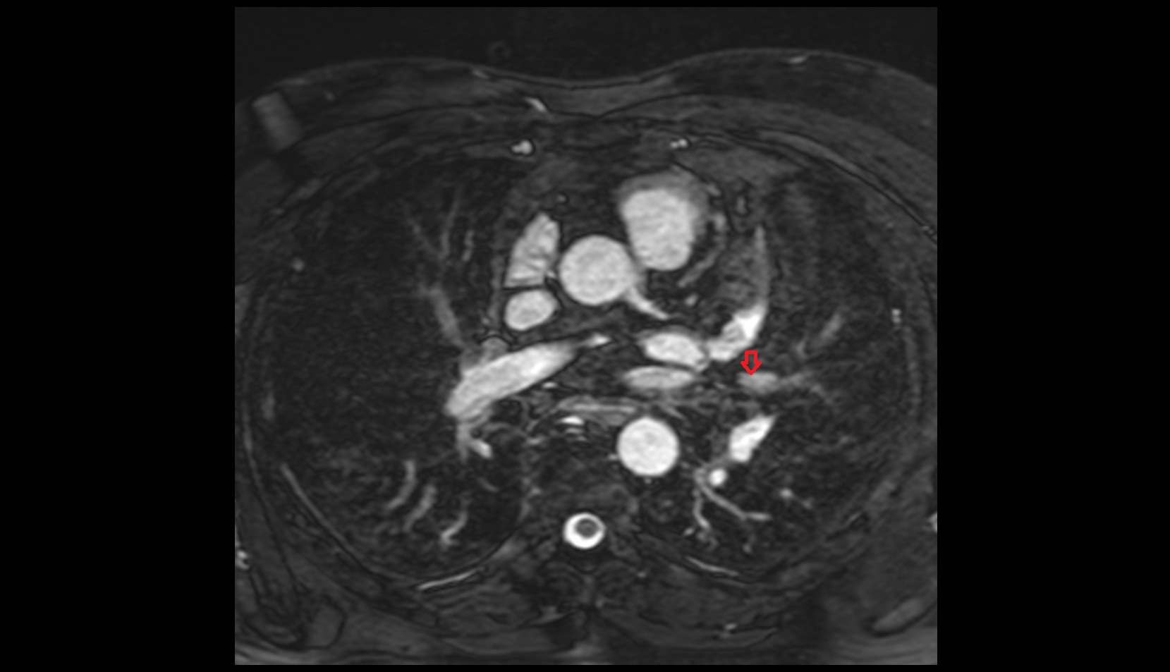 Inferior lingular vein of left lung mri axial image