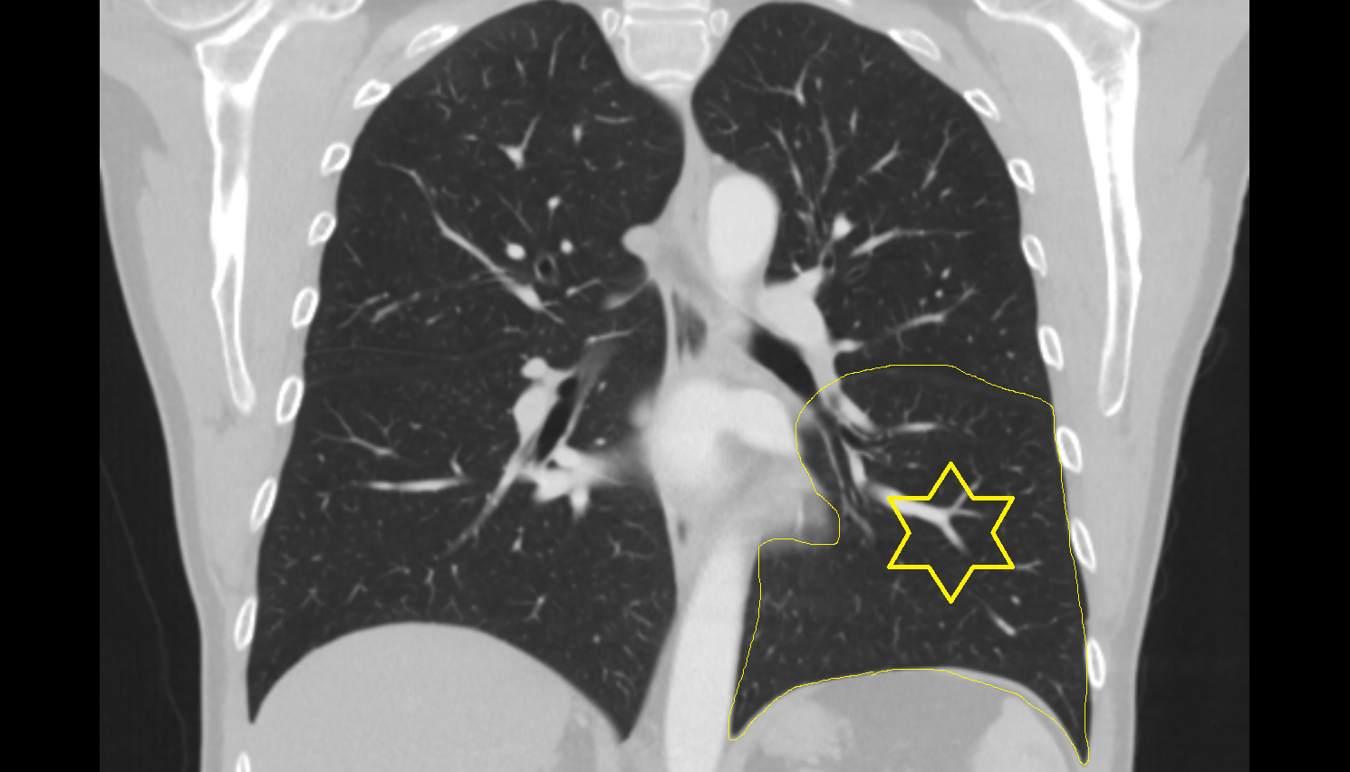 Inferior lobe of left lung CT anatomy image -img-00000-00000