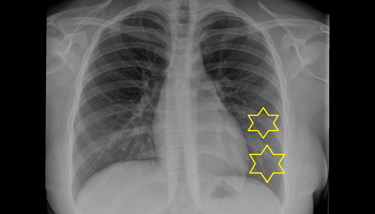 Inferior lobe of left lung X RAY anatomy image -img-00000-00000