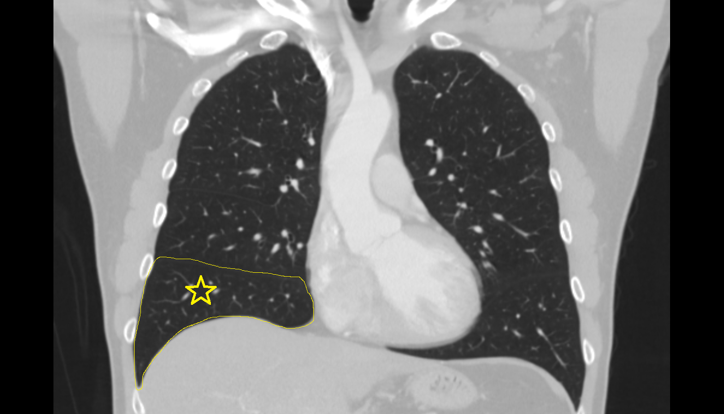 Inferior lobe of right lung of right lung CT anatomy image -img-00000-00000