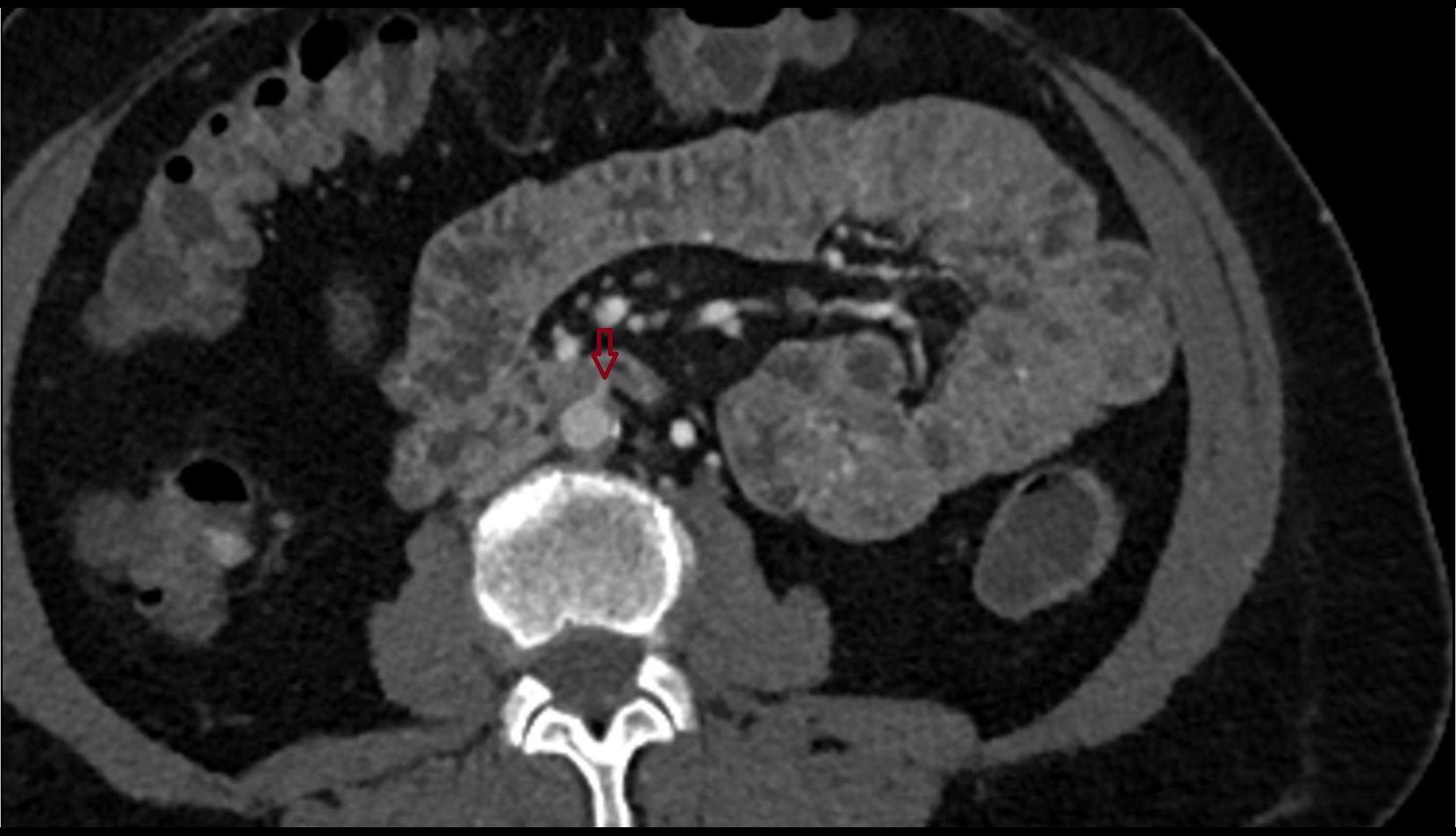 Inferior mesenteric artery (IMA)