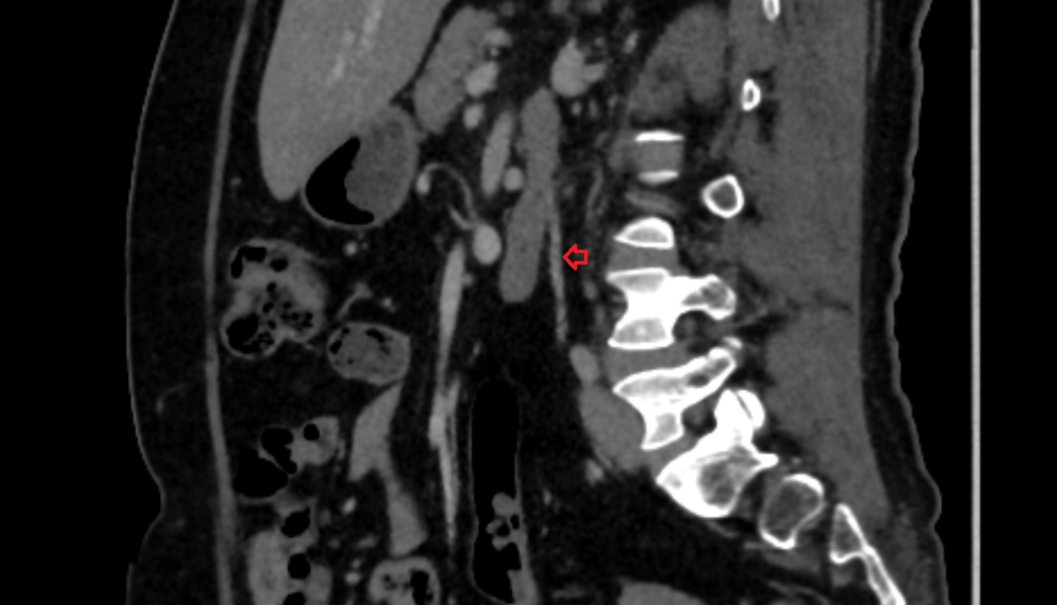 Inferior mesenteric artery (IMA) CT sag anatomy  image -img-00000-00000