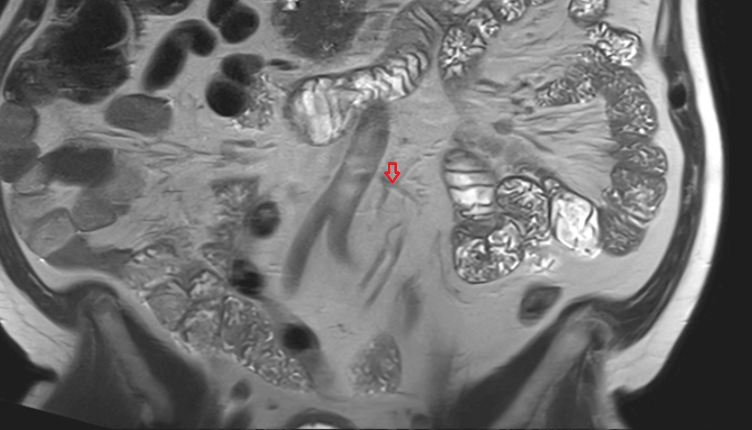 Inferior mesenteric artery (IMA) MRI coronal anatomy  image -img-00000-00000