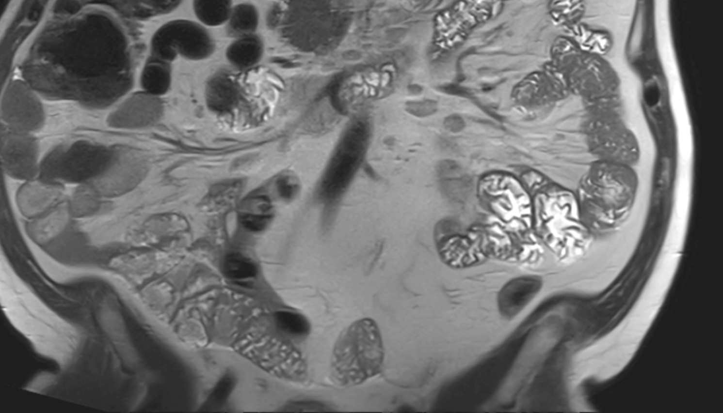 Inferior mesenteric artery (IMA) MRI coronal anatomy  image -img-00000-00000_00001
