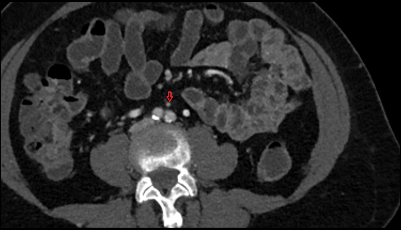 Inferior mesenteric artery (IMA) ct axial