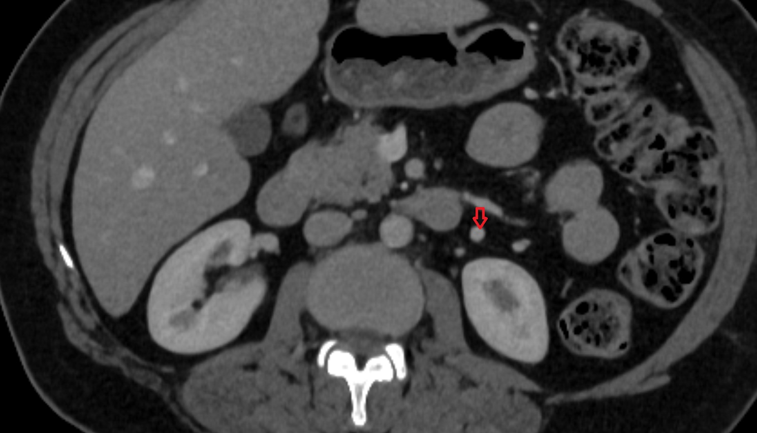 Inferior mesenteric vein  ct  axial  anatomy  image-img-00000-00000