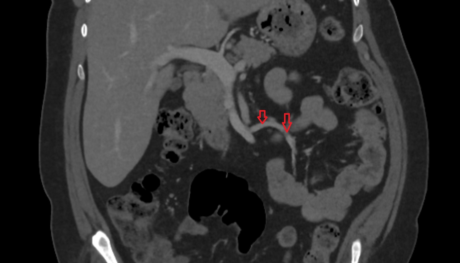 Inferior mesenteric vein  ct  coronal  anatomy  image-img-00000-00000