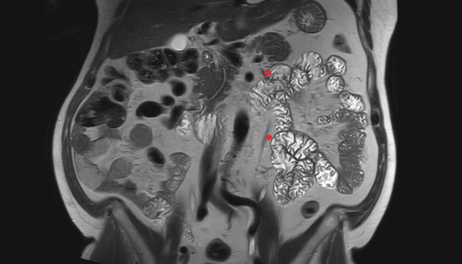 Inferior mesenteric vein  mri  coronal  anatomy  image-img-00000-00000