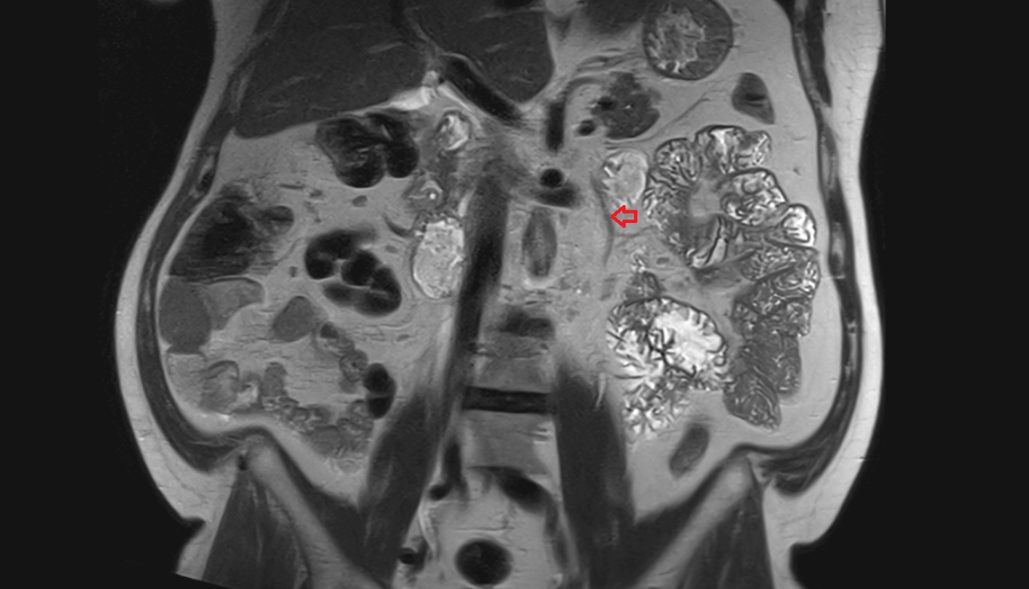 Inferior mesenteric vein  mri  coronal  anatomy  image-img-00000-00000_00001
