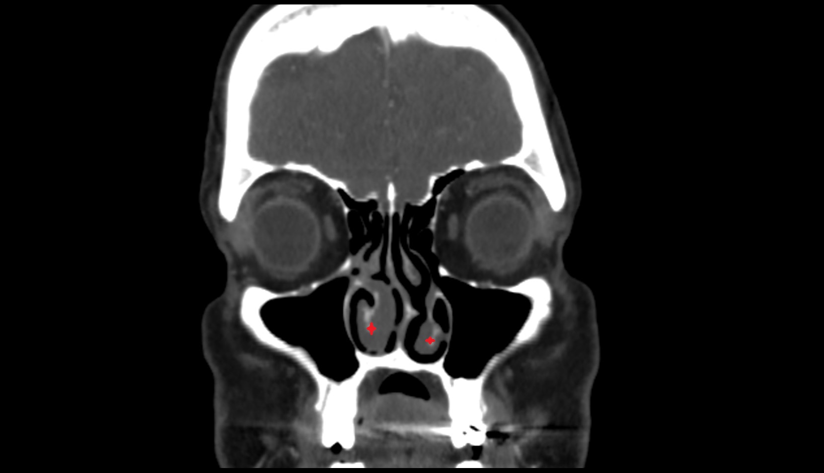 Inferior nasal concha