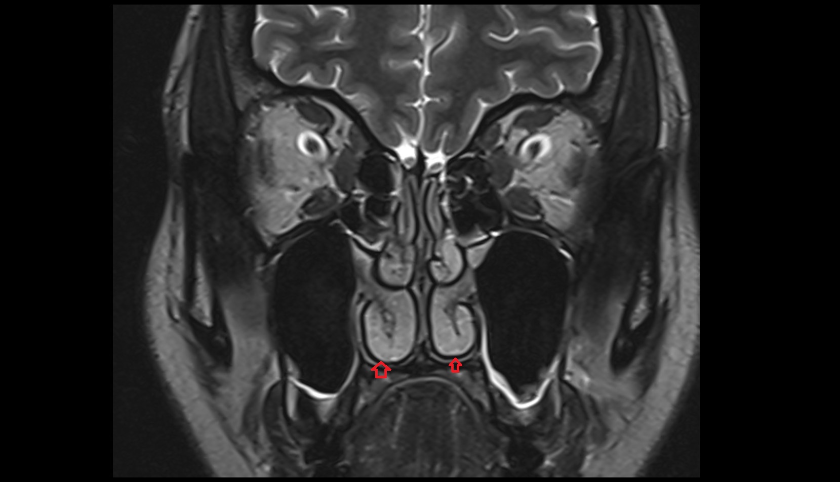 Inferior nasal meatus mri coronal image