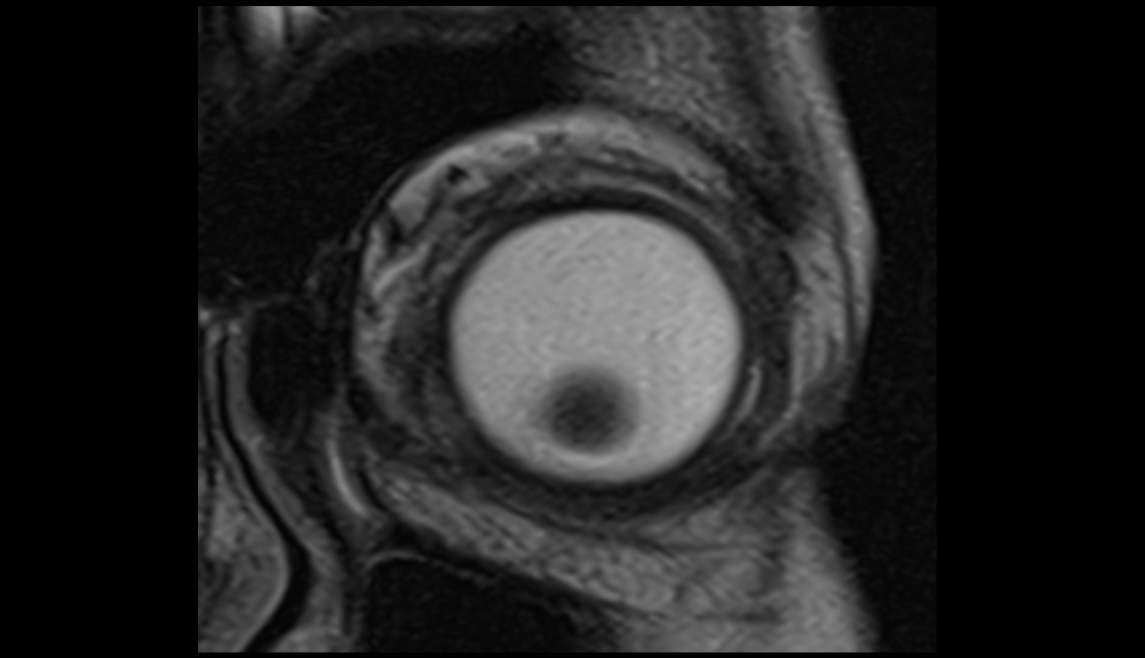 Inferior oblique muscle mri image