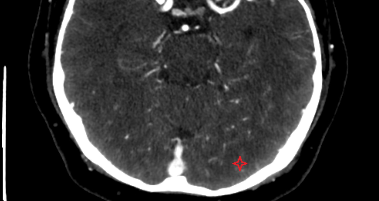 Inferior occipital gyrus  CT axial anatomy image -img-00001-00001