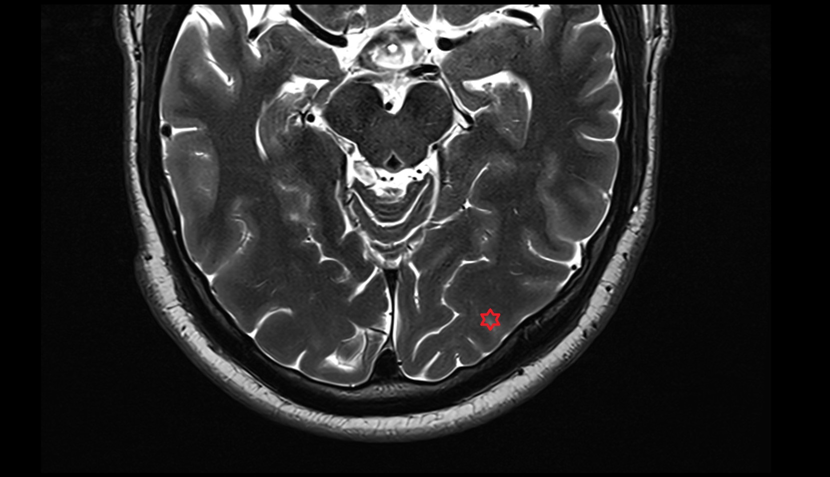 Inferior occipital gyrus mri 3t axial image
