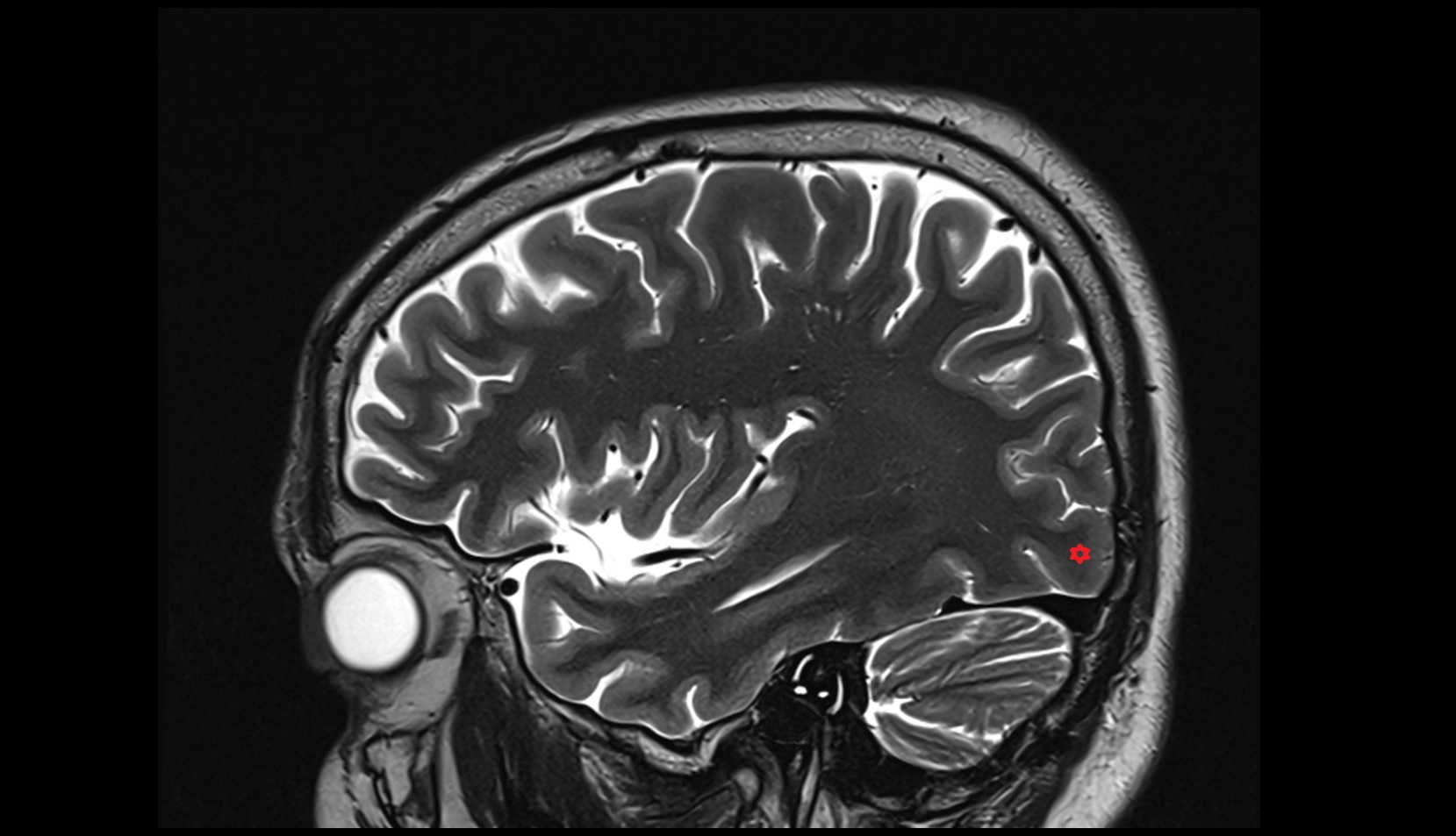 Inferior occipital gyrus mri 3t sagittal image