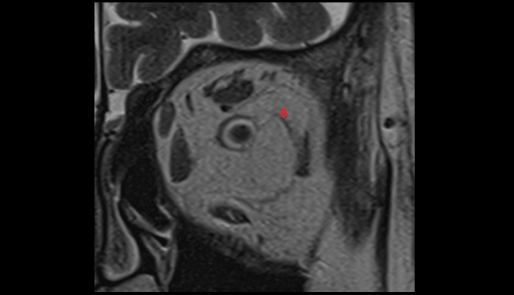 Inferior ophthalmic vein MRI coronal image