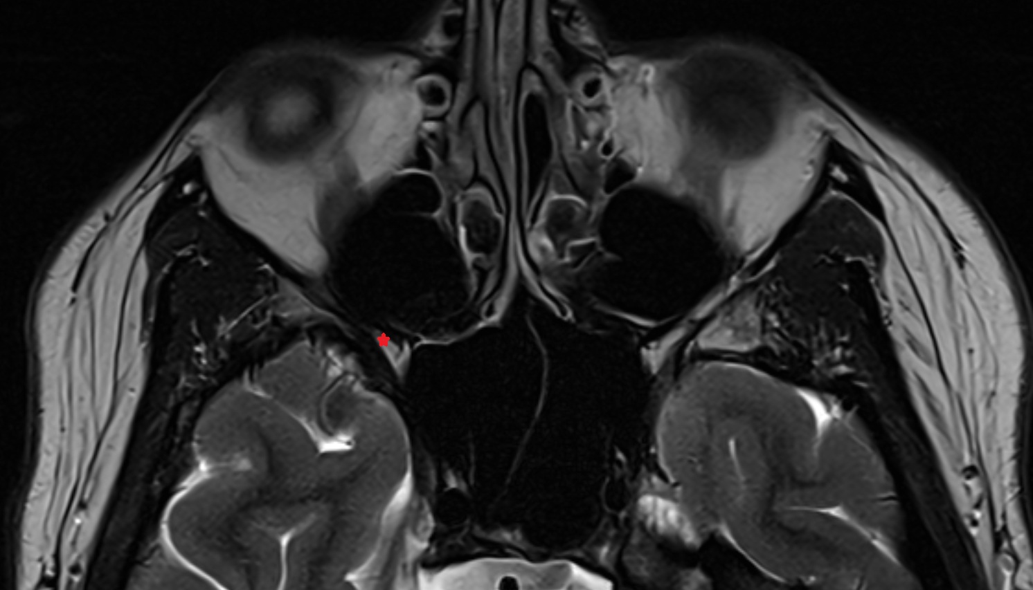 Inferior orbital fissure  mri axial  image -img-00000-00000
