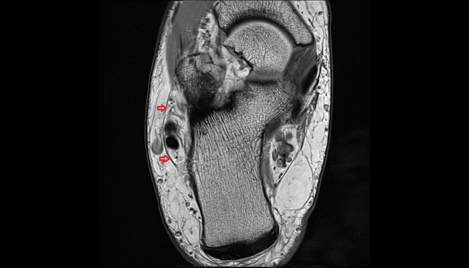 Inferior peroneal (fibular) retinaculum  axial  cross sectional anatomy 3T MRI AI enhanced radiology image-img-00000-00000