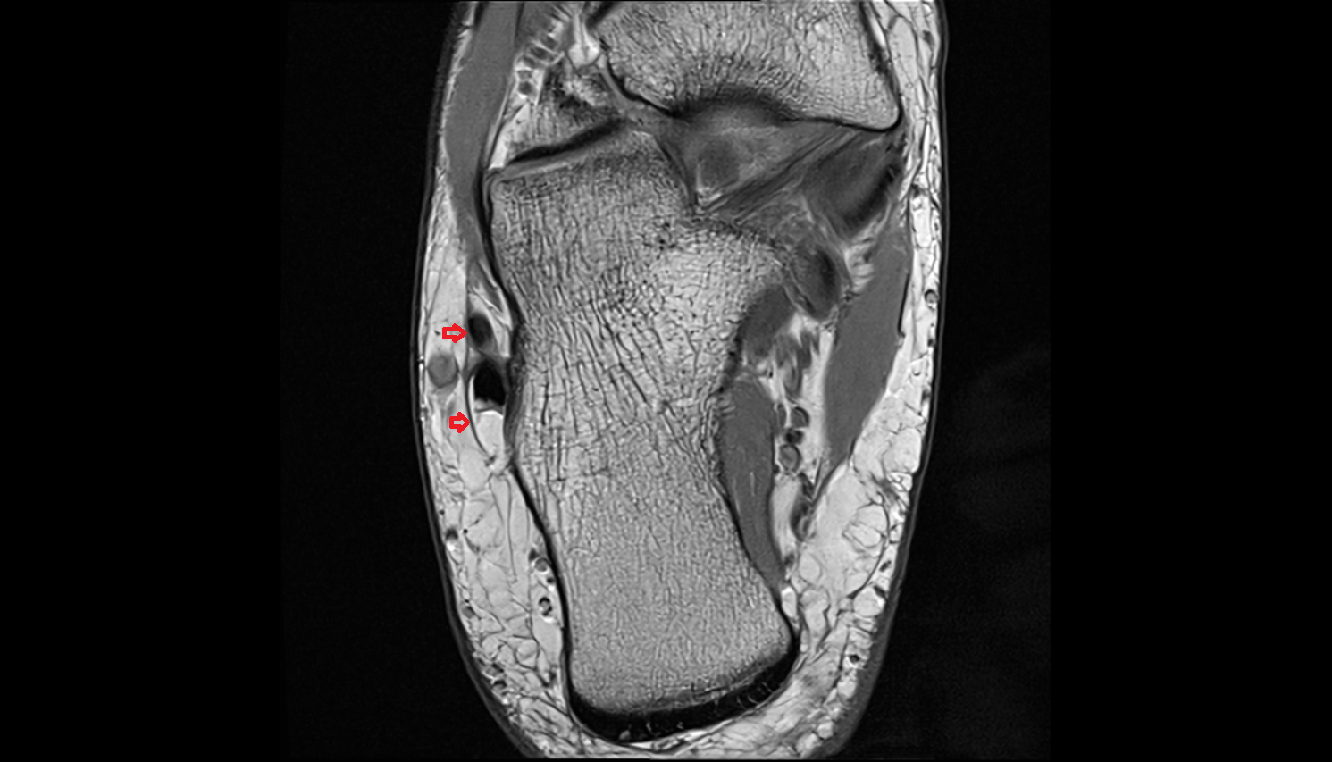 Inferior peroneal (fibular) retinaculum  axial  cross sectional anatomy 3T MRI AI enhanced radiology image-img-00000-00000_00001
