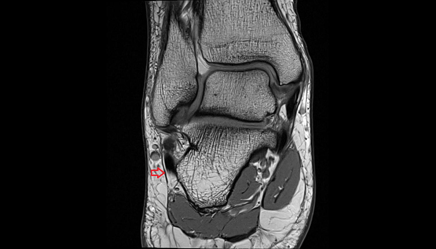 Inferior peroneal (fibular) retinaculum  coronal  cross sectional anatomy 3T MRI AI enhanced radiology image-img-00000-00000_00002