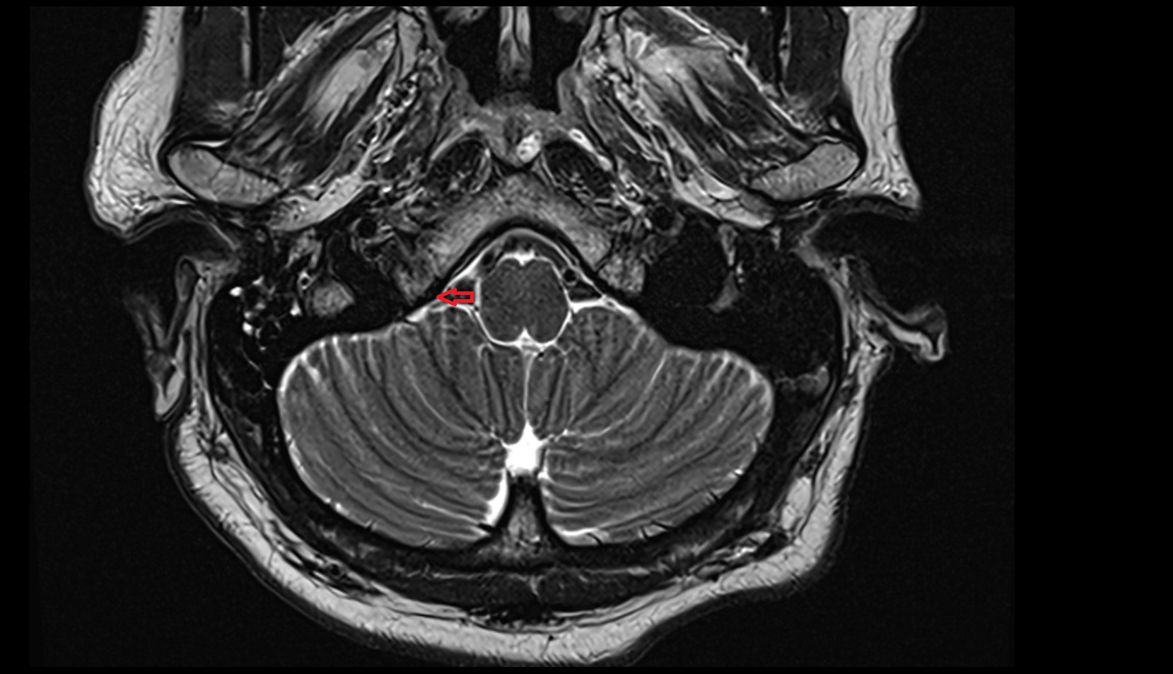 Inferior petrosal sinus MRI 3T axial image