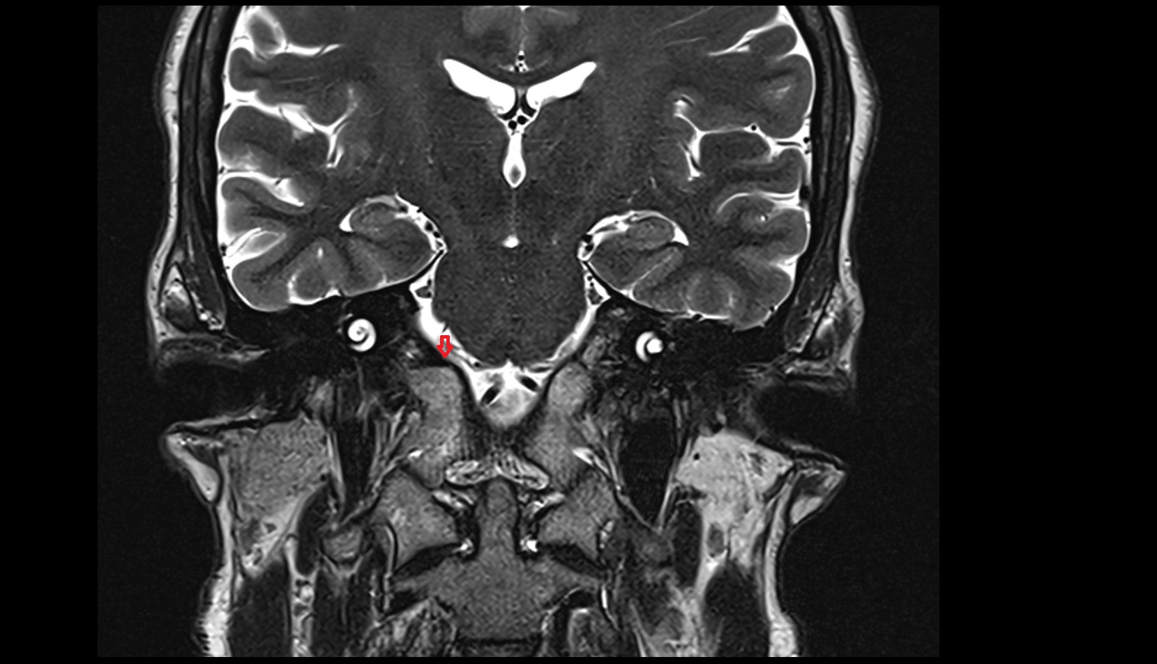 Inferior petrosal sinus MRI 3T coronal image